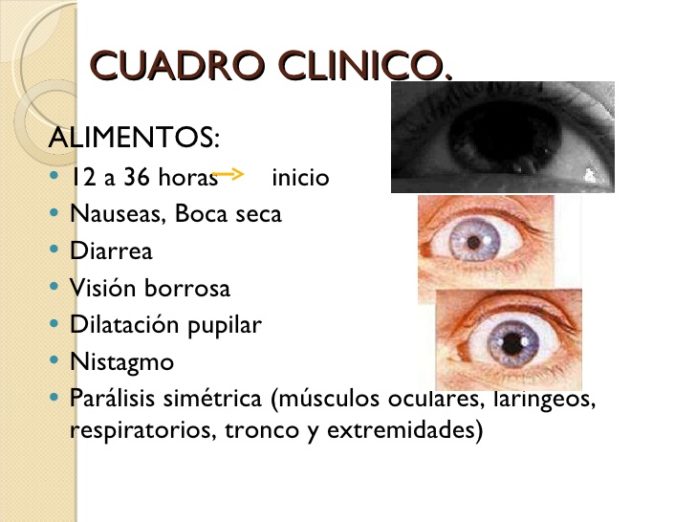 botulismo 9 728